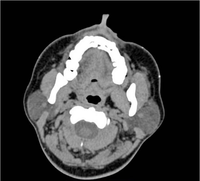File:Nasolabial cyst (Radiopaedia 25322-25580 Axial non-contrast 1).jpg