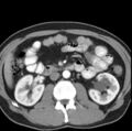 Necrotizing pancreatitis with acute necrotic collection (Radiopaedia 14470-14417 B 21).jpg