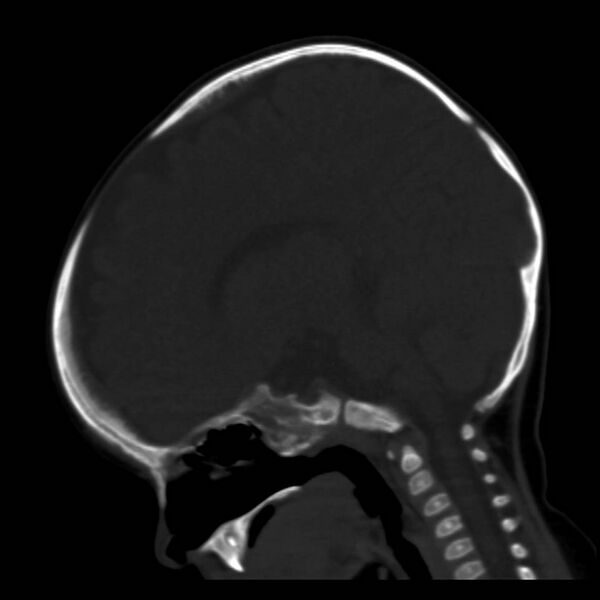 File:Neuroblastoma with skull metastases (Radiopaedia 30326-30958 Sagittal bone window 19).jpg