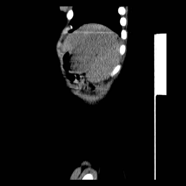 File:Neuroblastoma with skull metastases (Radiopaedia 30326-30960 B 43).jpg
