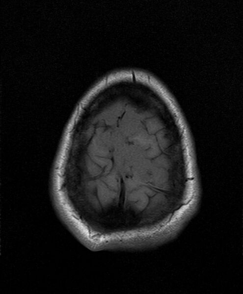 File:Neurofibromatosis type 2 (Radiopaedia 66211-75401 Axial T1 25).jpg