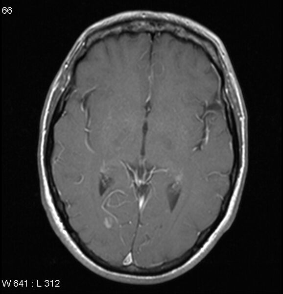 File:Neurosarcoidosis (Radiopaedia 10930-17204 Axial T1 C+ 9).jpg