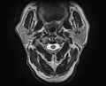 Non-Hodgkin lymphoma - parotid gland (Radiopaedia 71531-81890 Axial T2 14).jpg