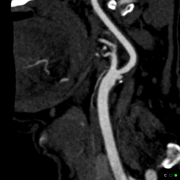 File:Non-occlusive intraluminal internal carotid artery thrombus (Radiopaedia 37751-39658 C 60).jpg