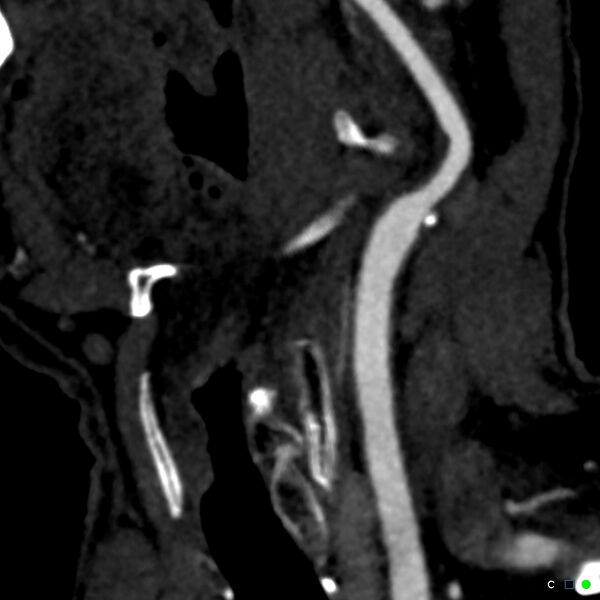 File:Non-occlusive intraluminal internal carotid artery thrombus (Radiopaedia 37751-39658 C 66).jpg