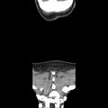 Normal CT of the neck (Radiopaedia 14575-14500 Coronal C+ 53).jpg