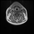 Normal cervical and thoracic spine MRI (Radiopaedia 35630-37156 Axial T1 C+ 19).png