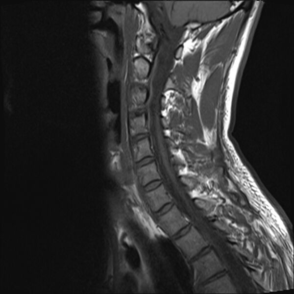 File:Normal cervical spine MRI (Radiopaedia 38418-40496 Sagittal T1 9).jpg