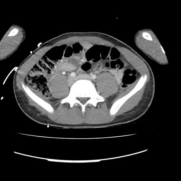 File:Normal dual-phase trauma CT chest,abdomen and pelvis (Radiopaedia 48092-52899 A 85).jpg