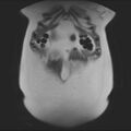 Normal liver MRI with Gadolinium (Radiopaedia 58913-66163 Coronal T2 8).jpg