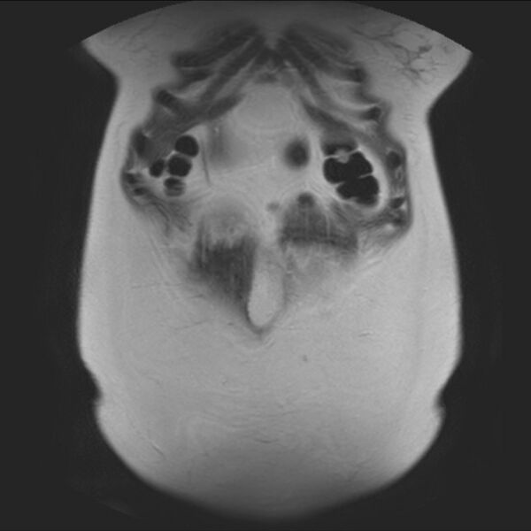 File:Normal liver MRI with Gadolinium (Radiopaedia 58913-66163 Coronal T2 8).jpg