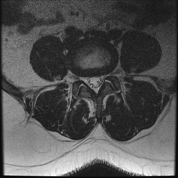 File:Normal lumbar spine MRI (Radiopaedia 43051-46311 Axial T2 18).jpg