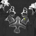 Occipital condyle fracture (Radiopaedia 18366-18209 Coronal 2).jpg