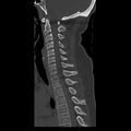 Occipital condyle fracture (Radiopaedia 31755-32691 Sagittal bone window 20).jpg