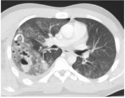 Pulmonary lacerations- Multiple focus of pulmonary lacerations can be depicted, some of them are filled with air, others filled with blood, and some filled with both, making an air-liquid level