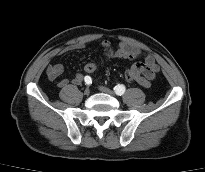 File:Abdominal aortic aneurysm (Radiopaedia 22421-22458 C+ arterial phase 69).jpg