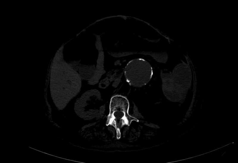 File:Abdominal aortic aneurysm - impending rupture (Radiopaedia 19233-19246 B 11).jpg