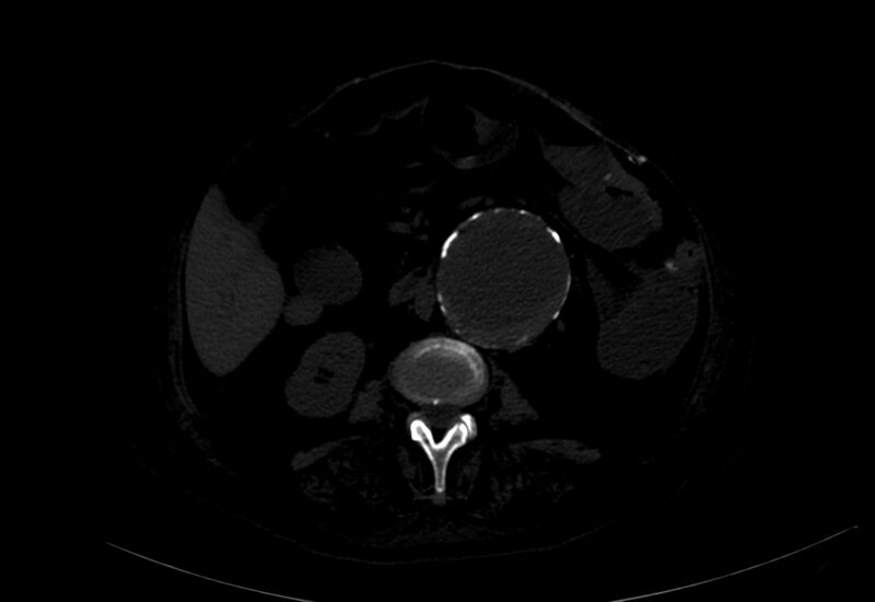 File:Abdominal aortic aneurysm - impending rupture (Radiopaedia 19233-19246 B 17).jpg