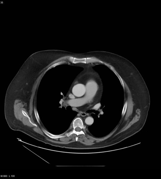 File:Abdominal aortic aneurysm with intramural hematoma then rupture (Radiopaedia 50278-55631 Axial C+ arterial phase 26).jpg