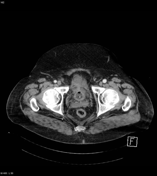 File:Abdominal aortic aneurysm with intramural hematoma then rupture (Radiopaedia 50278-55632 Axial C+ arterial phase 161).jpg