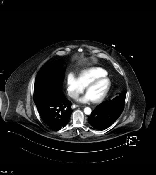 File:Abdominal aortic aneurysm with intramural hematoma then rupture (Radiopaedia 50278-55632 Axial C+ arterial phase 21).jpg