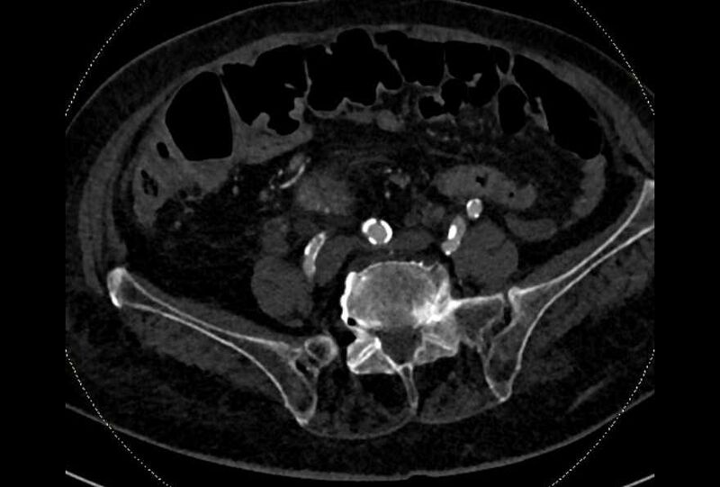 File:Abdominal aortic aneurysm with thrombus fissuration (Radiopaedia 73192-83919 Axial C+ arterial phase 151).jpg