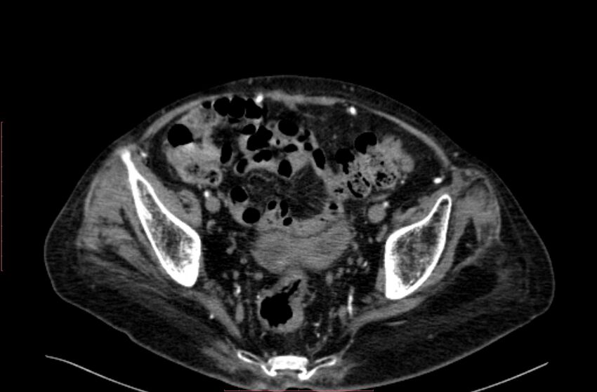 Abdominal aortic interposition tube graft and aneurysm thrombosis (Radiopaedia 71438-81857 Axial C+ arterial phase 199).jpg
