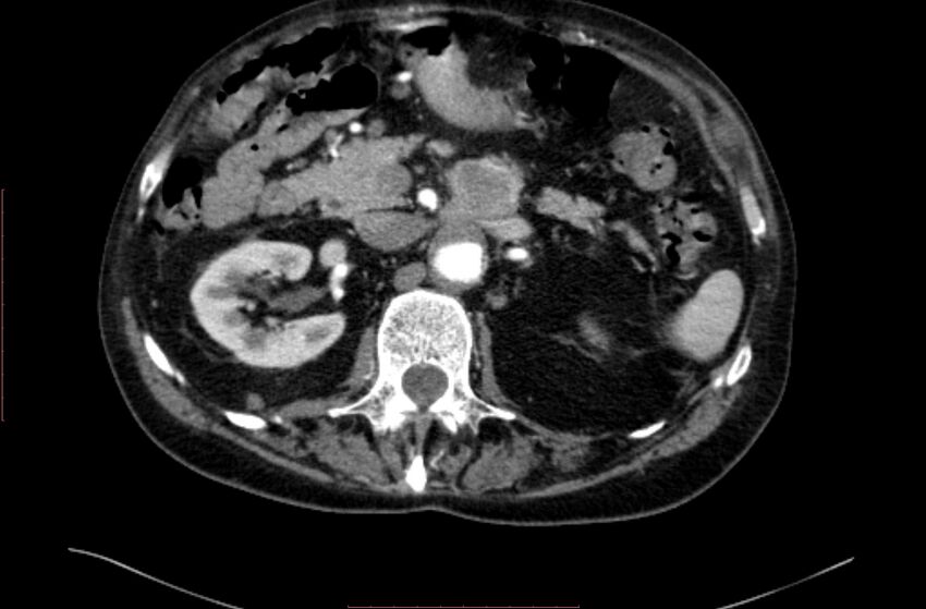 Abdominal aortic interposition tube graft and aneurysm thrombosis (Radiopaedia 71438-81857 Axial C+ arterial phase 41).jpg
