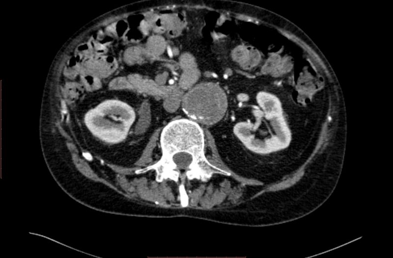 File:Abdominal aortic interposition tube graft and aneurysm thrombosis (Radiopaedia 71438-81857 Axial C+ arterial phase 64).jpg