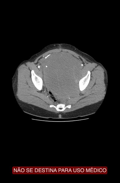 File:Abdominal desmoid tumor (Radiopaedia 44024-47540 Axial C+ arterial phase 43).jpg