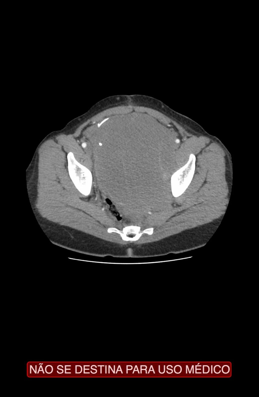 Abdominal desmoid tumor (Radiopaedia 44024-47540 Axial C+ arterial phase 43).jpg