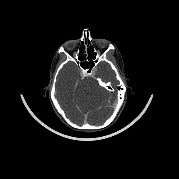File:Aberrant right internal carotid artery (Radiopaedia 65191-74197 Axial C+ arterial phase 12).jpg