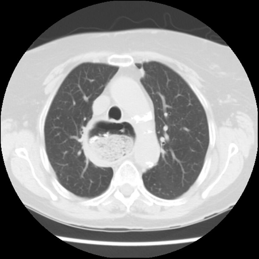 Achalasia (Radiopaedia 44094-47649 Axial lung window 19).jpg