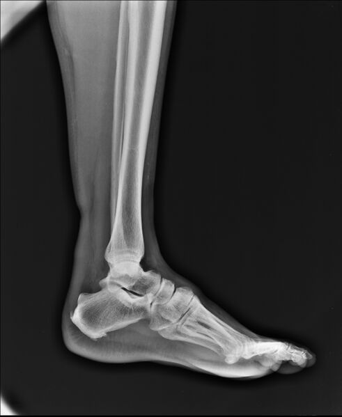 File:Achilles tendon tear (Radiopaedia 18551-18420 Lateral 1).jpg