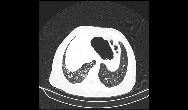 File:Acquired tracheo-esophageal fistula (Radiopaedia 51356-57103 Axial lung window 35).jpg
