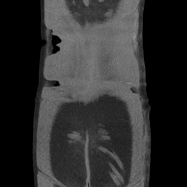 File:Active colonic bleed on CT (Radiopaedia 49765-55025 Coronal art MIP 60).jpg