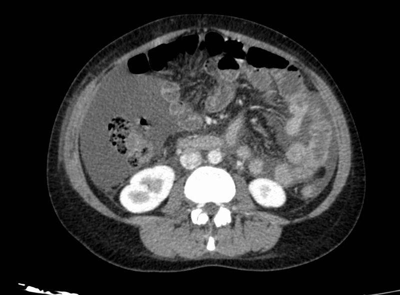 File:Acute Budd-Chiari syndrome (Radiopaedia 60858-68638 Axial C+ portal venous phase 155).jpg