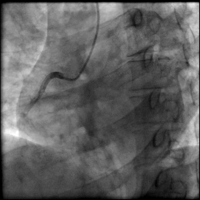 Acute anteroseptal myocardial infarction (Radiopaedia 68409-77946 RAO straight RCA 9).jpg
