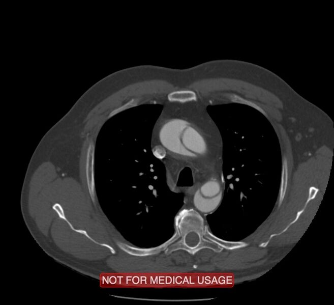 File:Acute aortic dissection - Stanford type A (Radiopaedia 40661-43285 Axial C+ arterial phase 12).jpg