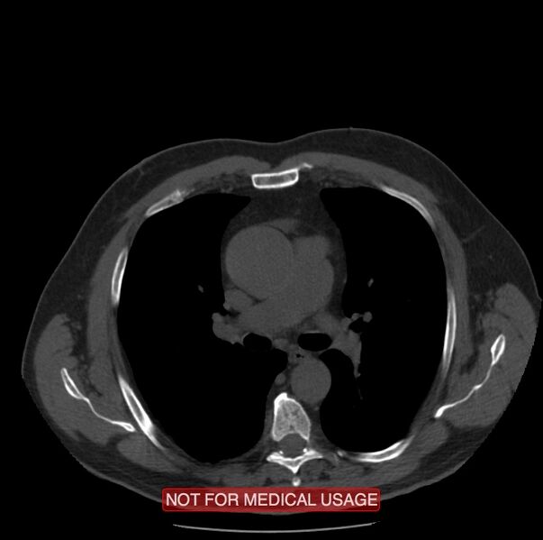 File:Acute aortic dissection - Stanford type A (Radiopaedia 40661-43285 Axial non-contrast 21).jpg