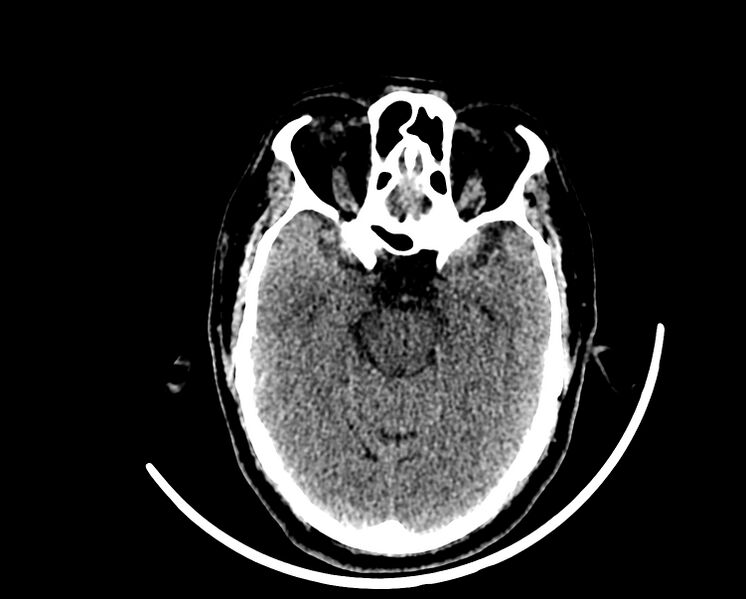File:Acute cerebral infarct (Radiopaedia 35604-37123 Axial non-contrast 37).jpg