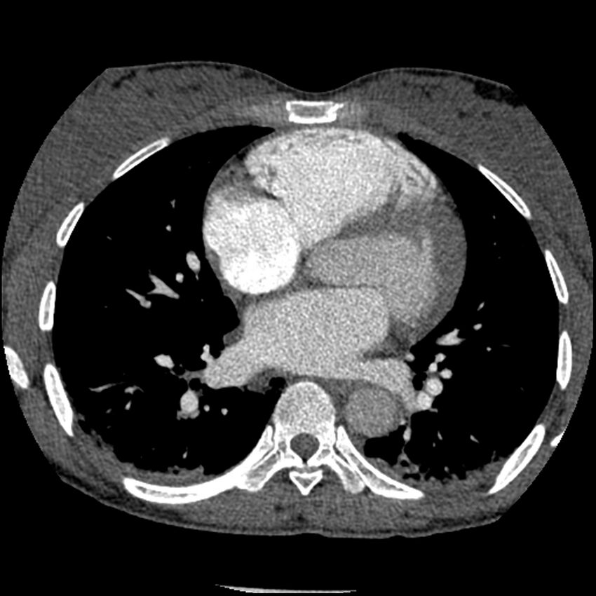 Acute chest syndrome - sickle cell disease (Radiopaedia 42375-45499 Axial C+ CTPA 107).jpg