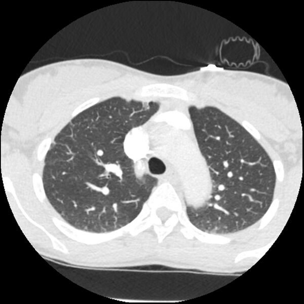 File:Acute chest syndrome - sickle cell disease (Radiopaedia 42375-45499 Axial lung window 58).jpg
