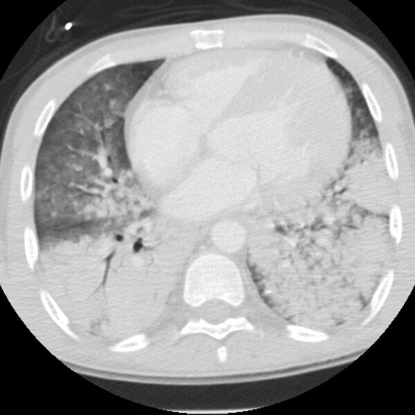 File:Acute diffuse alveolar hemorrhage (Radiopaedia 41323-44158 Axial lung window 38).jpg