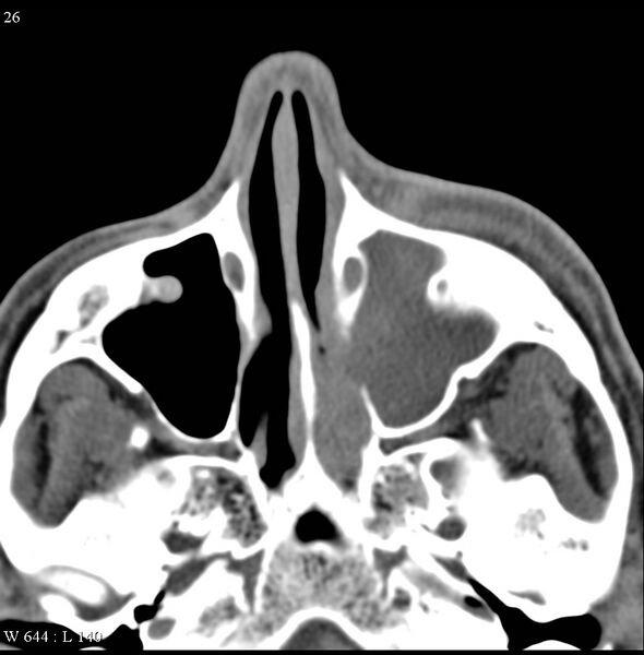 File:Acute maxillary sinusitis (Radiopaedia 4890-6825 Axial non-contrast 1).jpg
