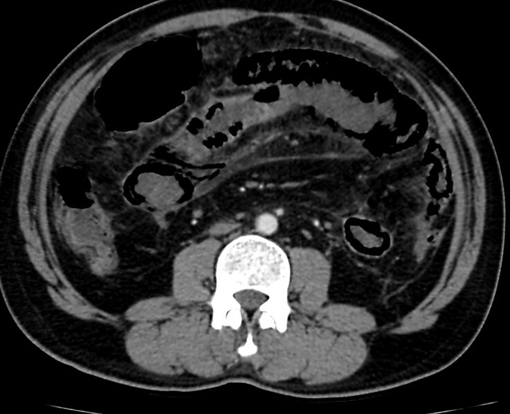 File:Acute mesenteric ischemia - superior mesenteric artery thrombosis (Radiopaedia 73947-84776 Axial C+ arterial phase 69).jpg