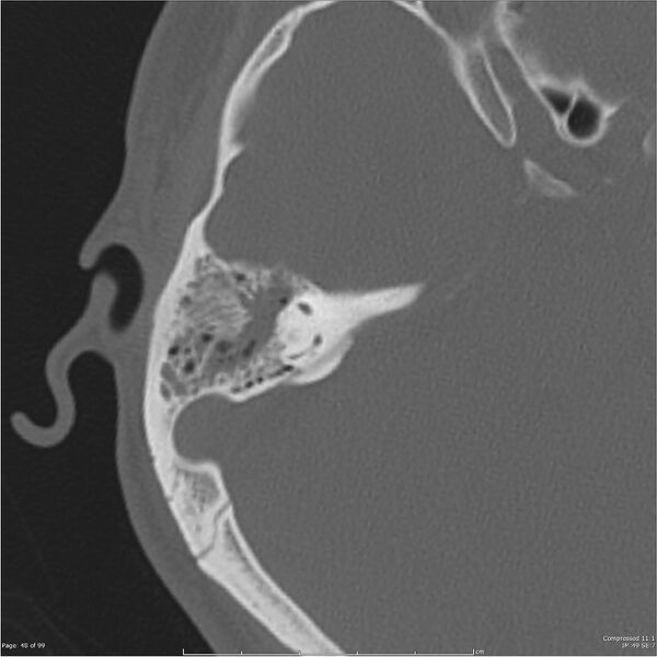 File:Acute otomastoiditis (Radiopaedia 28276-28512 Axial PTB bone window reformat 28).jpg