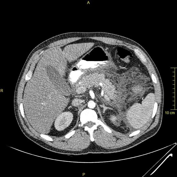 File:Acute pancreatitis (Radiopaedia 23231-23290 Axial C+ arterial phase 31).JPG