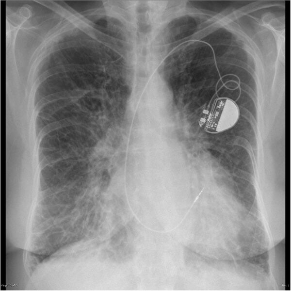 File:Acute pulmonary edema (Radiopaedia 15434-15204 Frontal 1).jpg