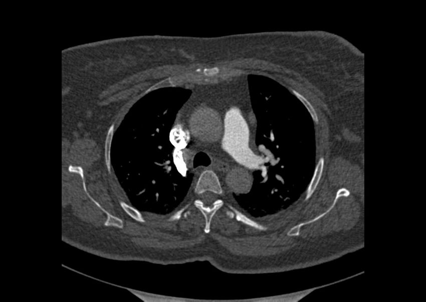 Acute pulmonary embolism (Radiopaedia 29938-30466 Axial C+ CTPA 21).jpg